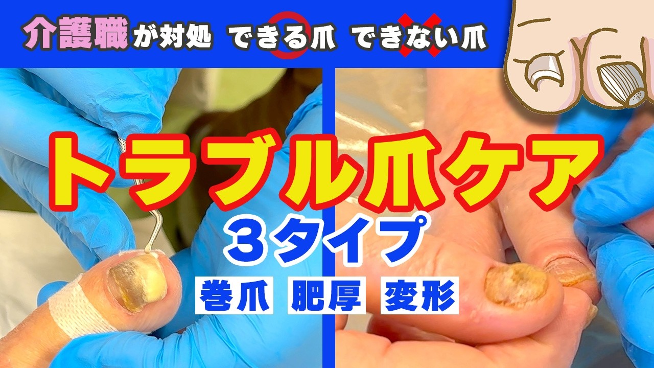 【現場解説】介護職ができるトラブル爪のケア方法（肥厚爪・外傷性変形・巻き爪）