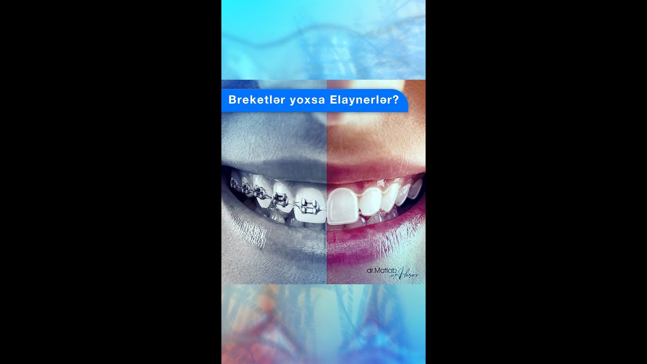 Breketlər yoxsa elaynerlər? | Dr. Matlab Alasov / #breket #aligners #baku #implant