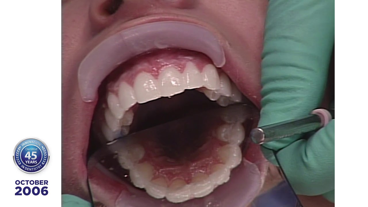 Dr. Robert Ibsen Presents Chris R., a Lumineers® Clinical Case Presentation: 2006