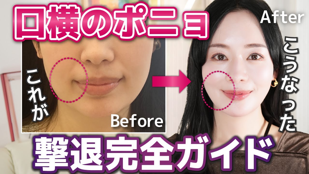 口横のポニョをやっつけて【-5歳】若返る方法を美容のプロが原因＆解説