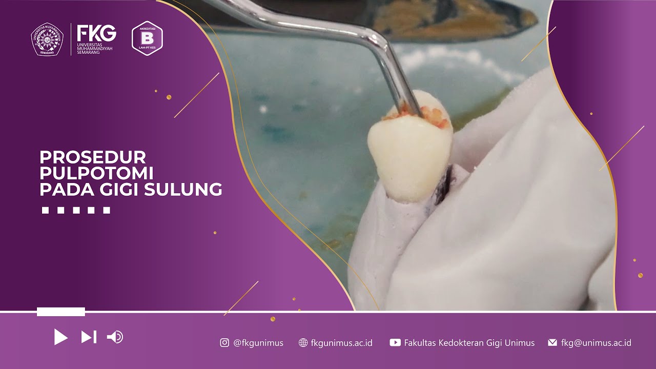 Prosedur PULPOTOMI  Pada Gigi Sulung