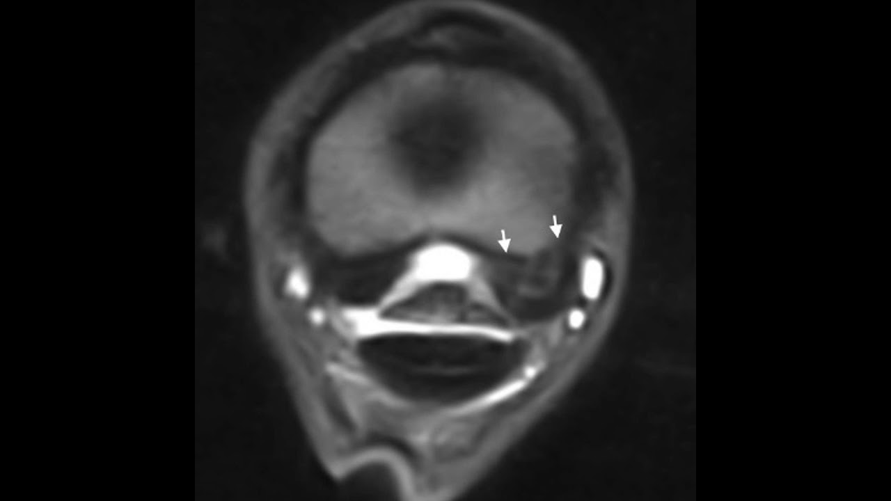 Episode 12 - Suspensory Ligaments