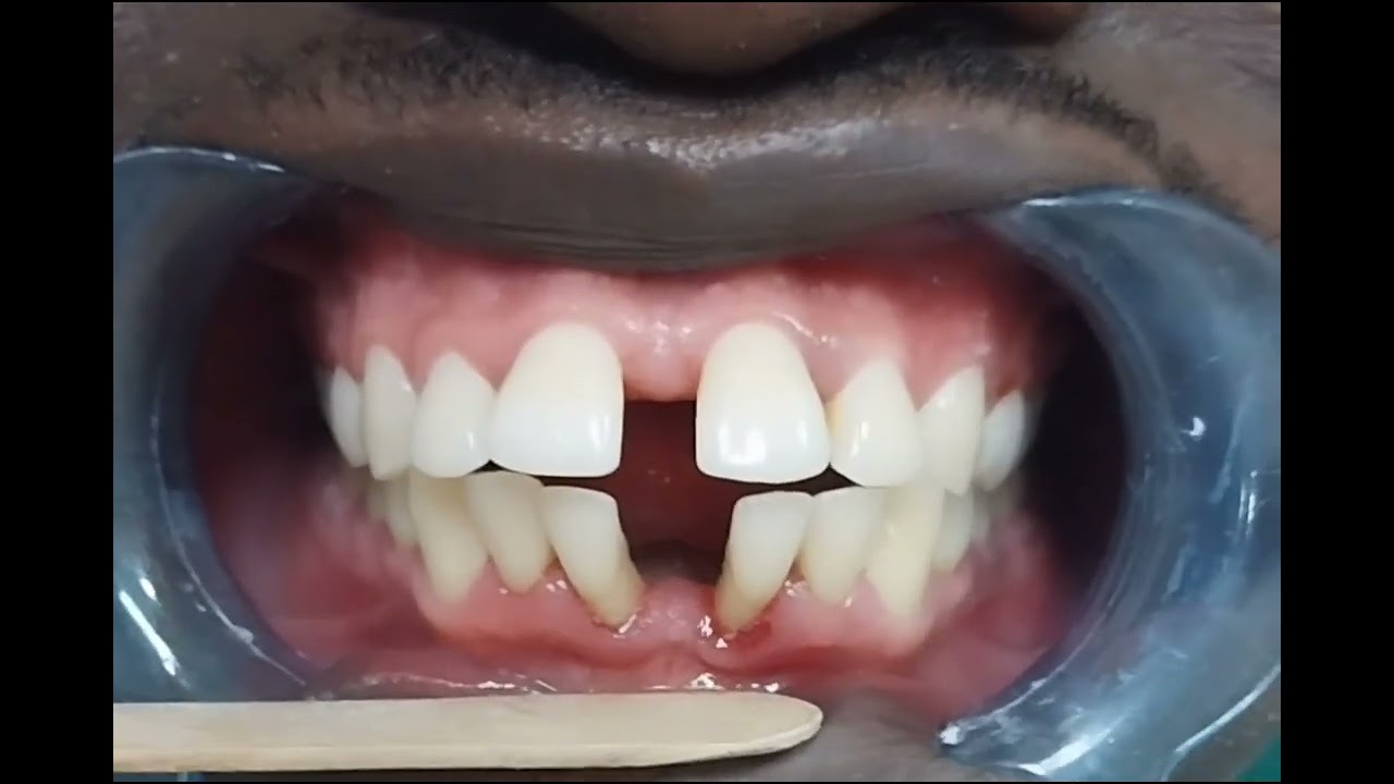 Fixed Orthodontics is a proven mode of treatment. God's copy vs Human intervention.