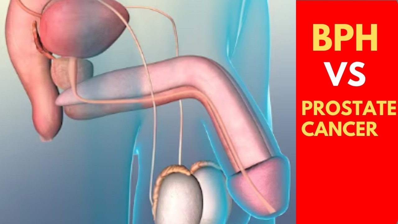 Benign Prostatic Hyperplasia (BPH) vs. Prostate Cancer