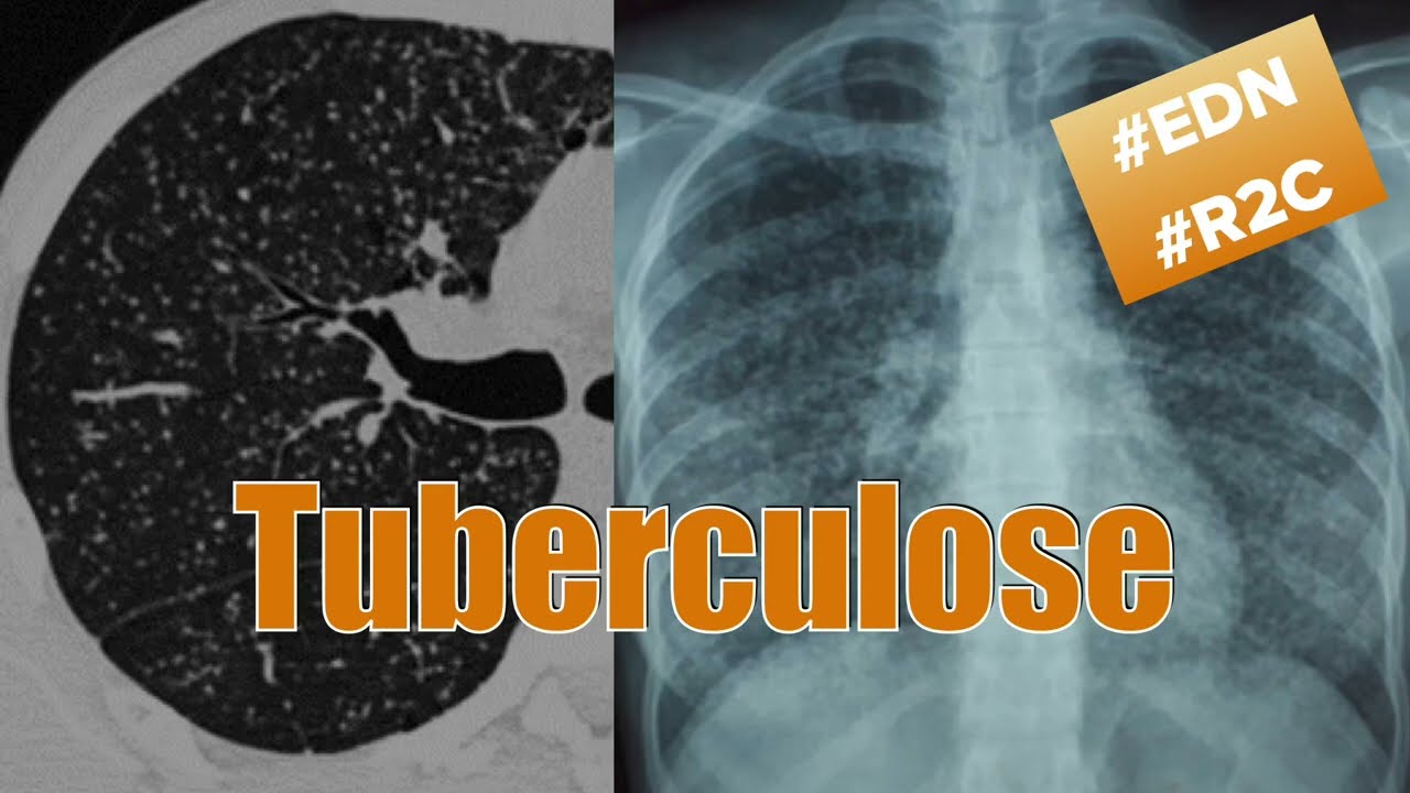 Tuberculose - Item 159, ce qu'il faut apprendre pour l'EDN de médecine selon la R2C