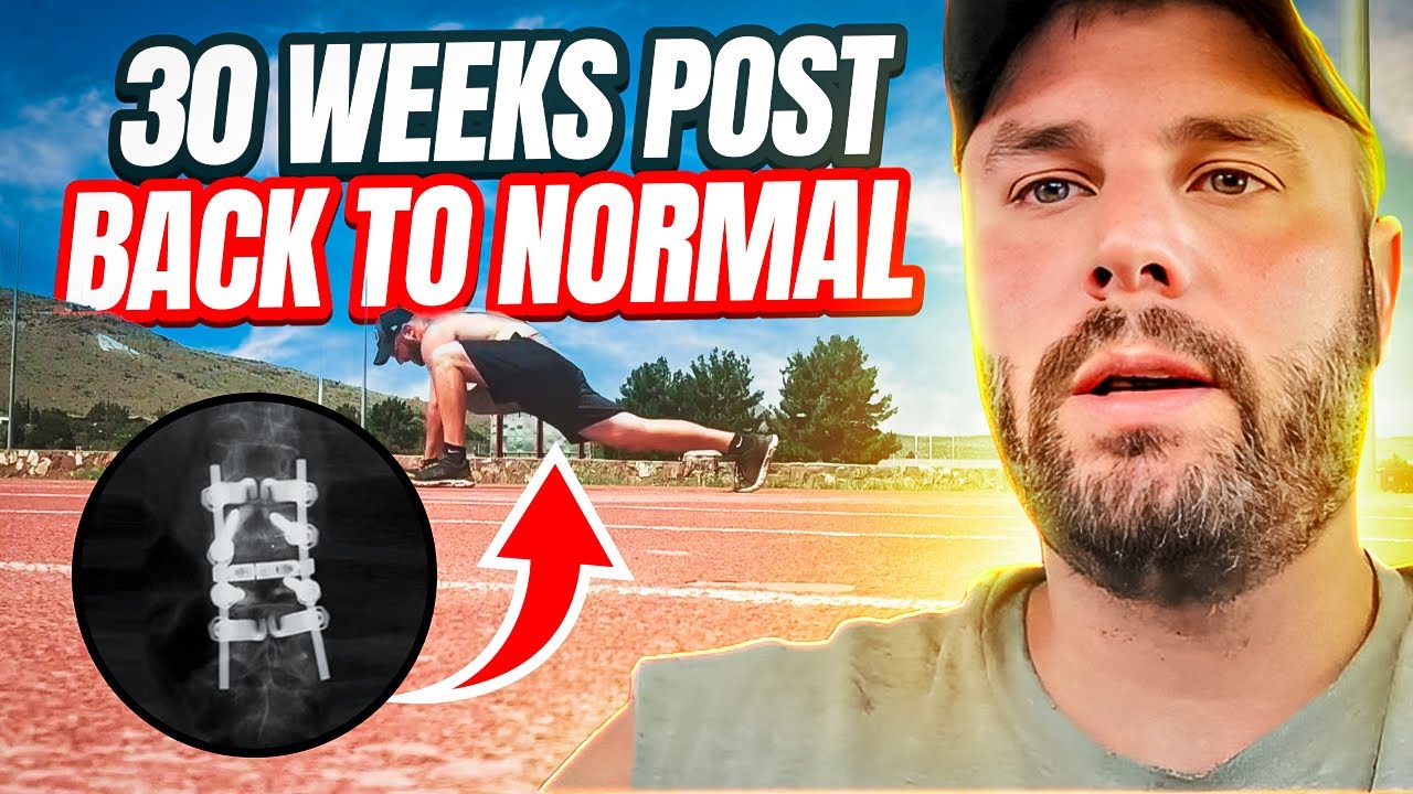 Spinal Fusion Recovery - 30 Weeks In - Getting Back To Normal?