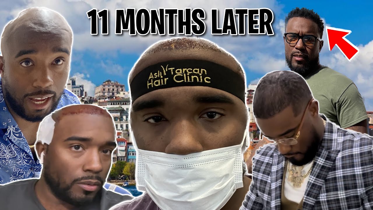 ASLI TARCAN FUE HAIR TRANSPLANT 11 POST OP UPDATE [5 COMMON HAIR TRANSPLANT QUESTIONS]