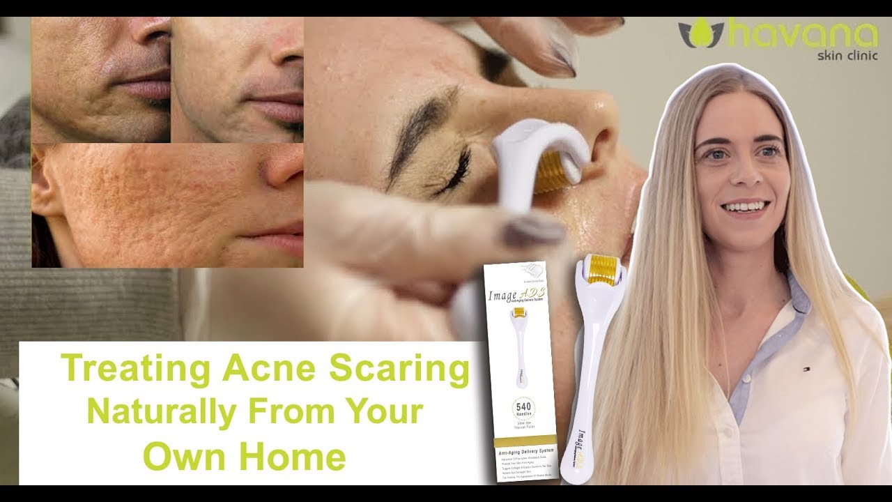 How To Properly Treat Acne Scaring - Dermaroller Breakdown