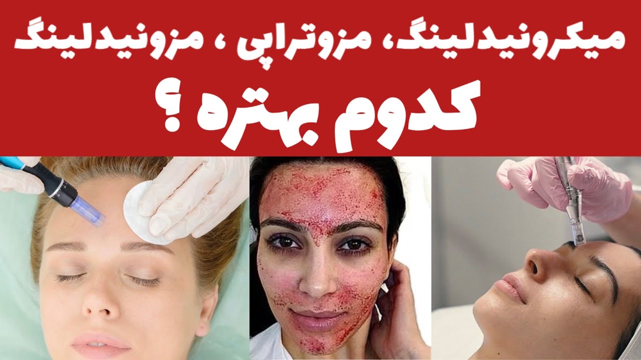 فرق میکرونیدلینگ و مزوتراپی و مزونیدلینگ چیه؟