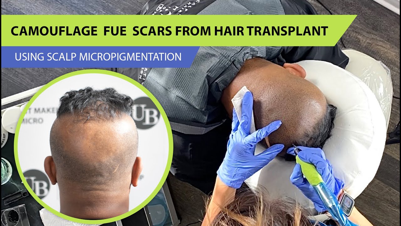Micropigmentacion Capilar Despues de Transplante de Cabello | Unyozi Beauty