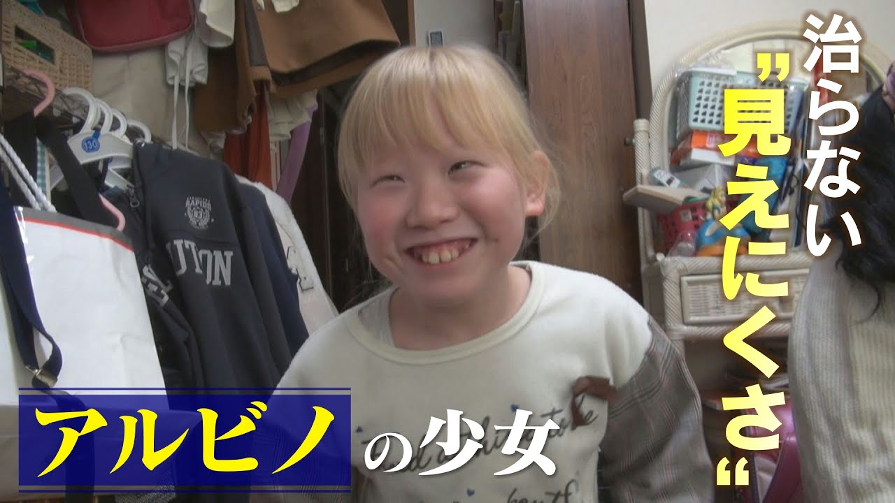 2万人に1人の難病“アルビノ”の少女‥色素が薄いだけでなく弱視との闘い「宿題も鬼ごっこも大変です」CBCドキュメンタリー