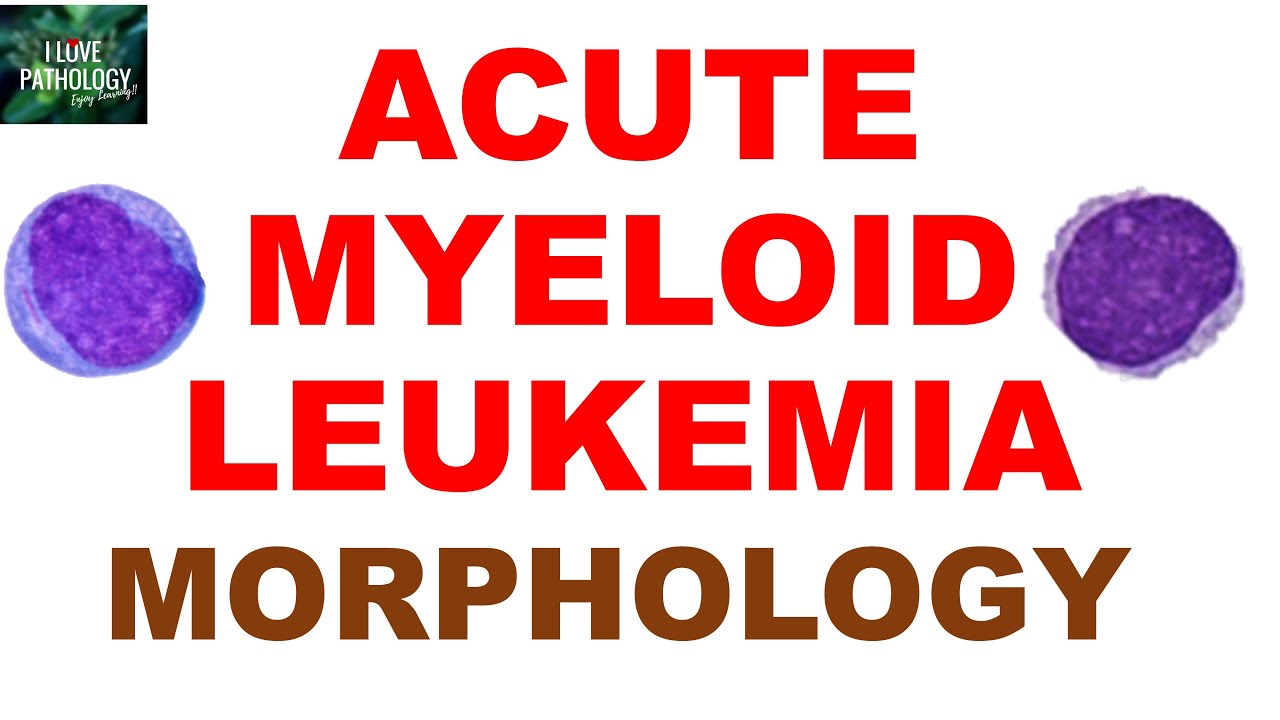 White Blood Cell Neoplasms  – Part 3: ACUTE MYELOID LEUKEMIA - CLASSIFICATION, PATHOGENESIS
