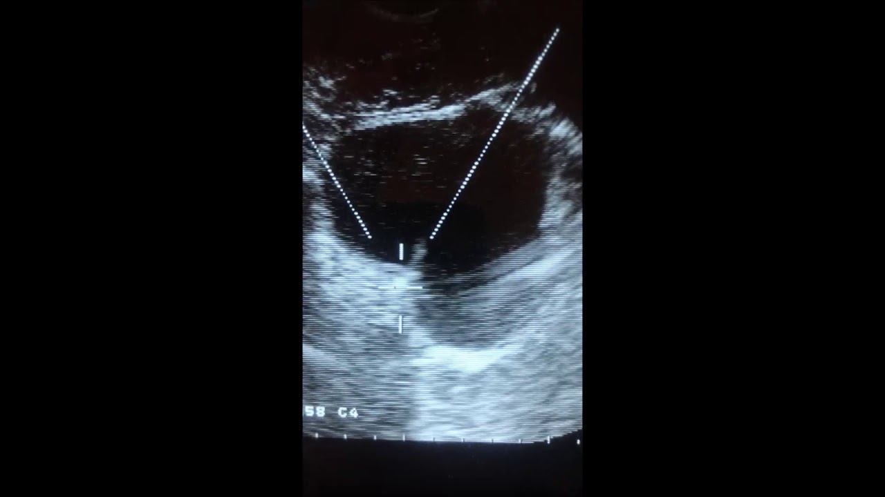 SWL of urinary stone in ureter by Storz modulith SLK. Dr. Grabsky A.M.