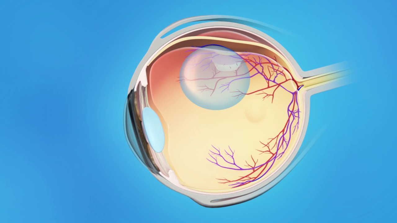 Retina Detached Pneumatic Retinopexy