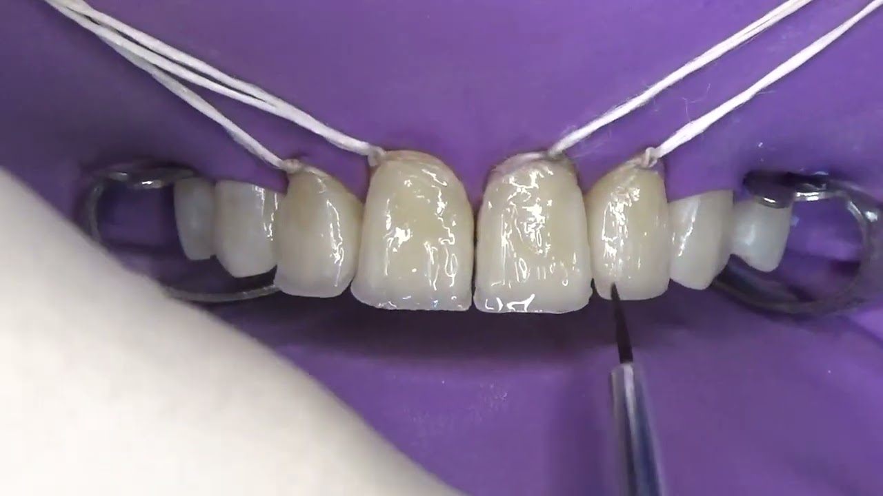Resina Composta Em Dentes Anteriores