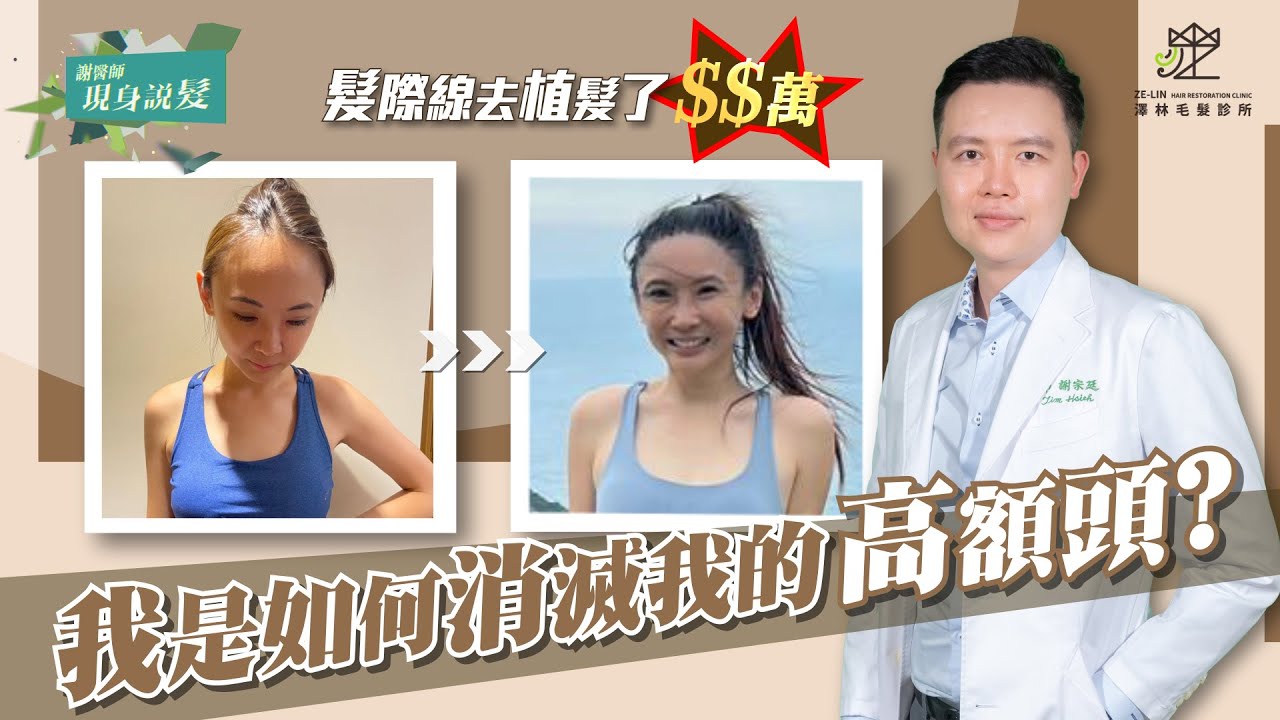 女生髮際線植髮心得分享｜搶救高額頭靠這招