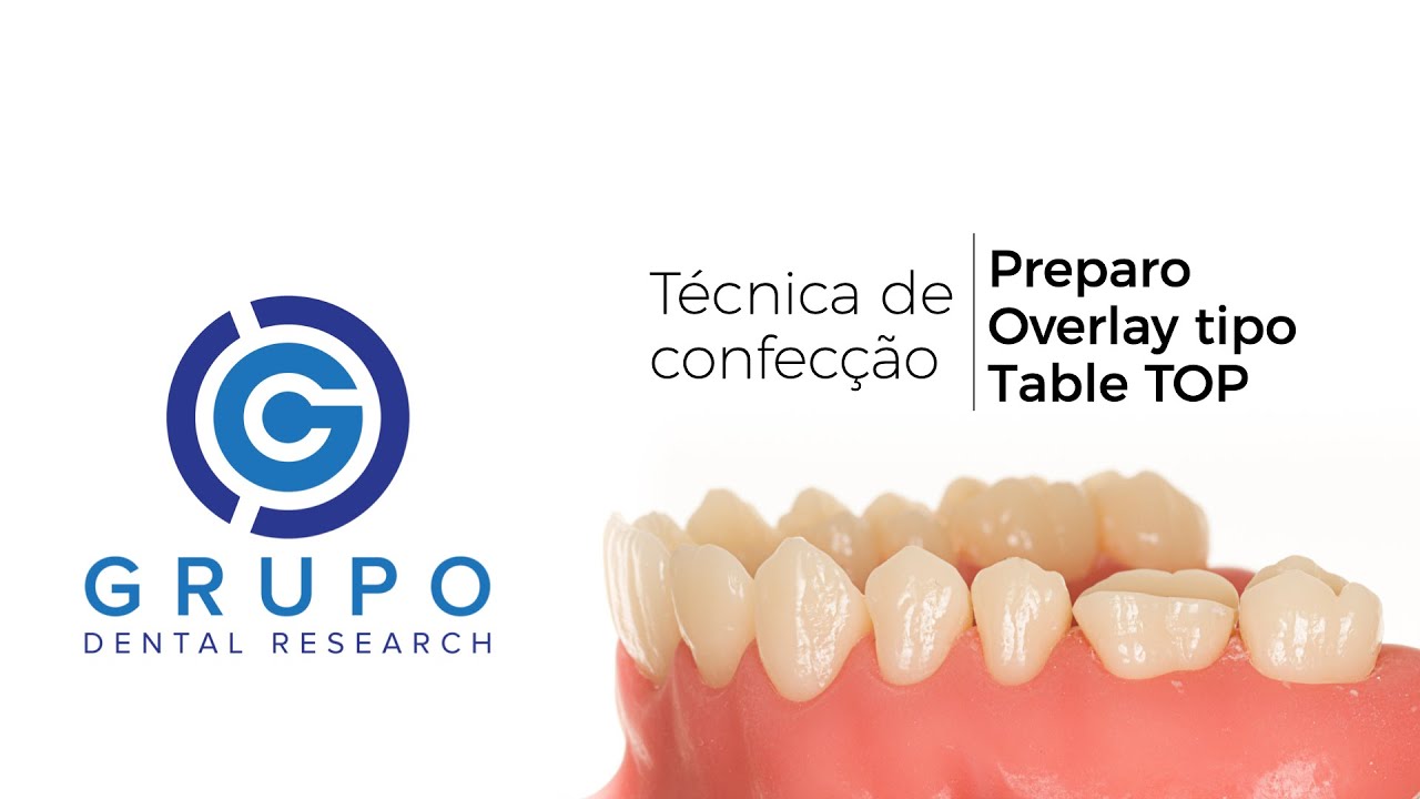Preparo dental de Onlay tipo 