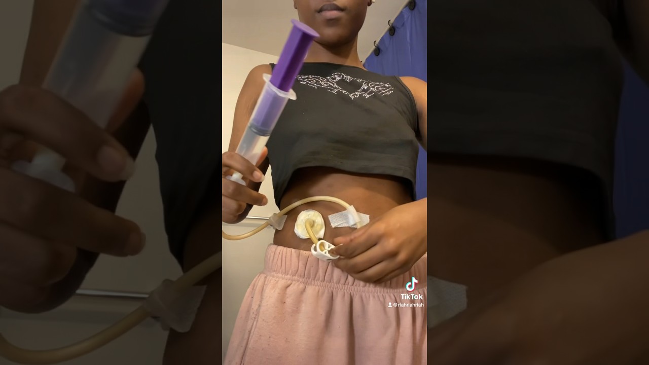 set up my feeding tube feeds with me! #shorts #gastroparesis