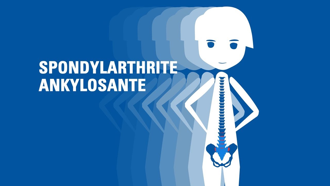 Qu'est-ce que la spondylarthrite ankylosante?