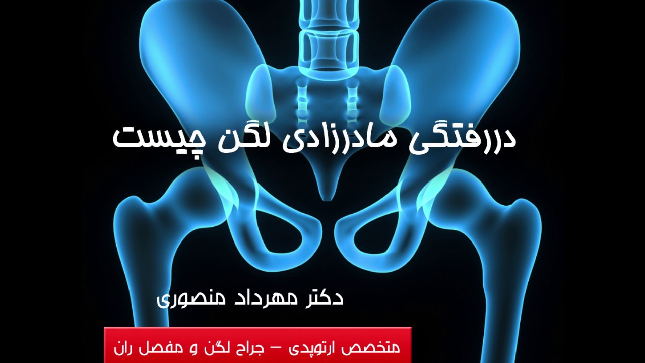 دررفتگی مادرزادی لگن چیست