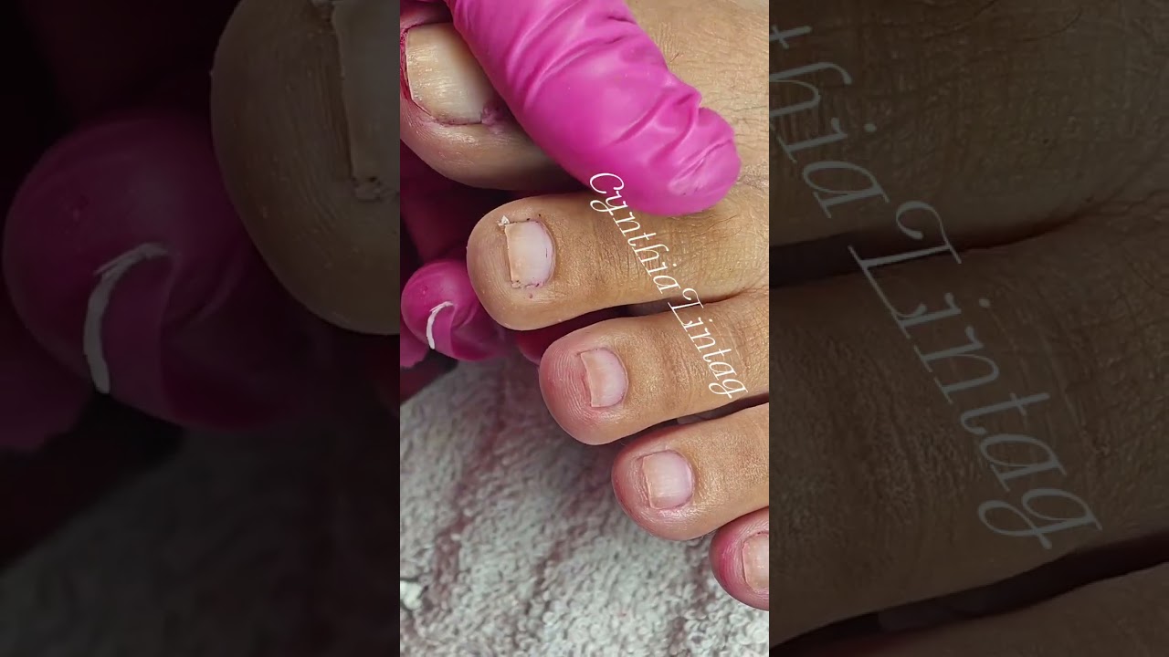 Full video pedicure with ingrown removal 