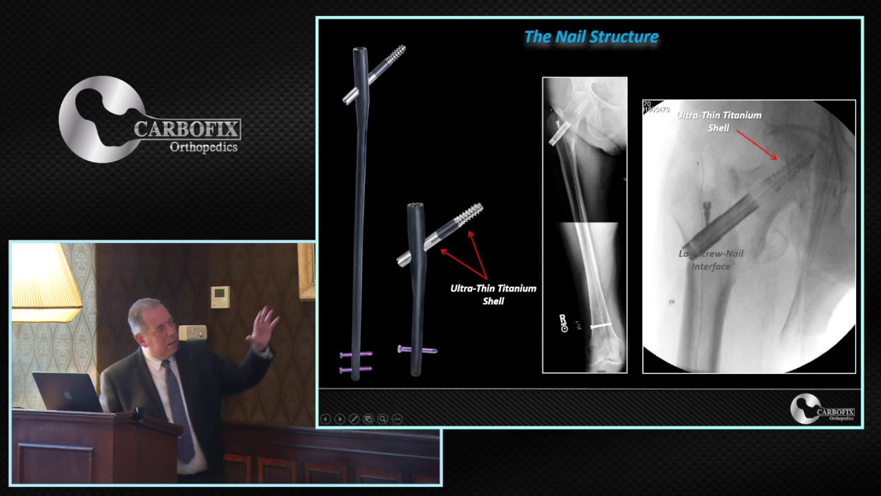 Carbon Fiber Composite Material In Orthopedic Oncology: Evolutionary, Revolutionary