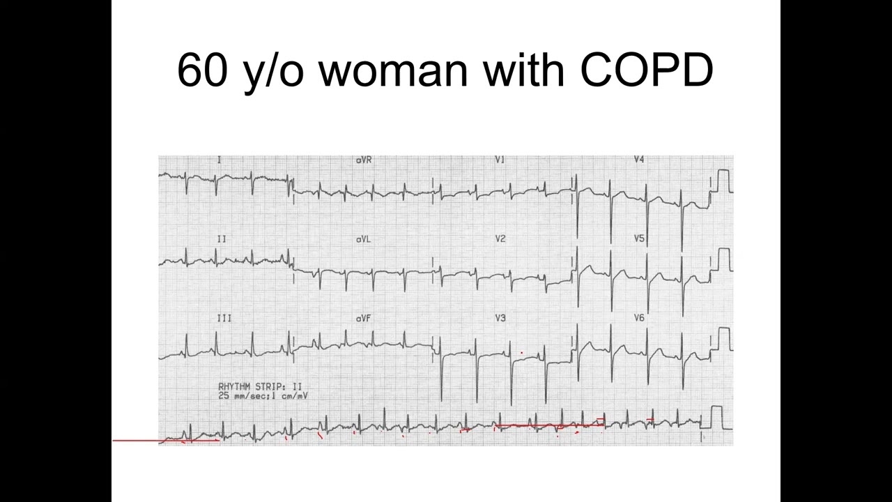 Basic ECG course: Interesting ECG cases
