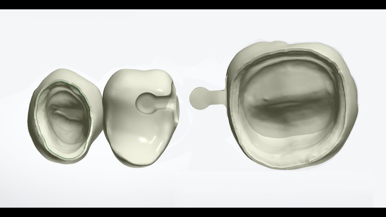 Split Bridge with Male & Female Connector 3Shape Dental System 15.4.0.
