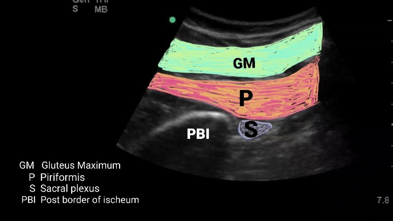 Ultrasound guided parasacral approach of the sciatic nerve