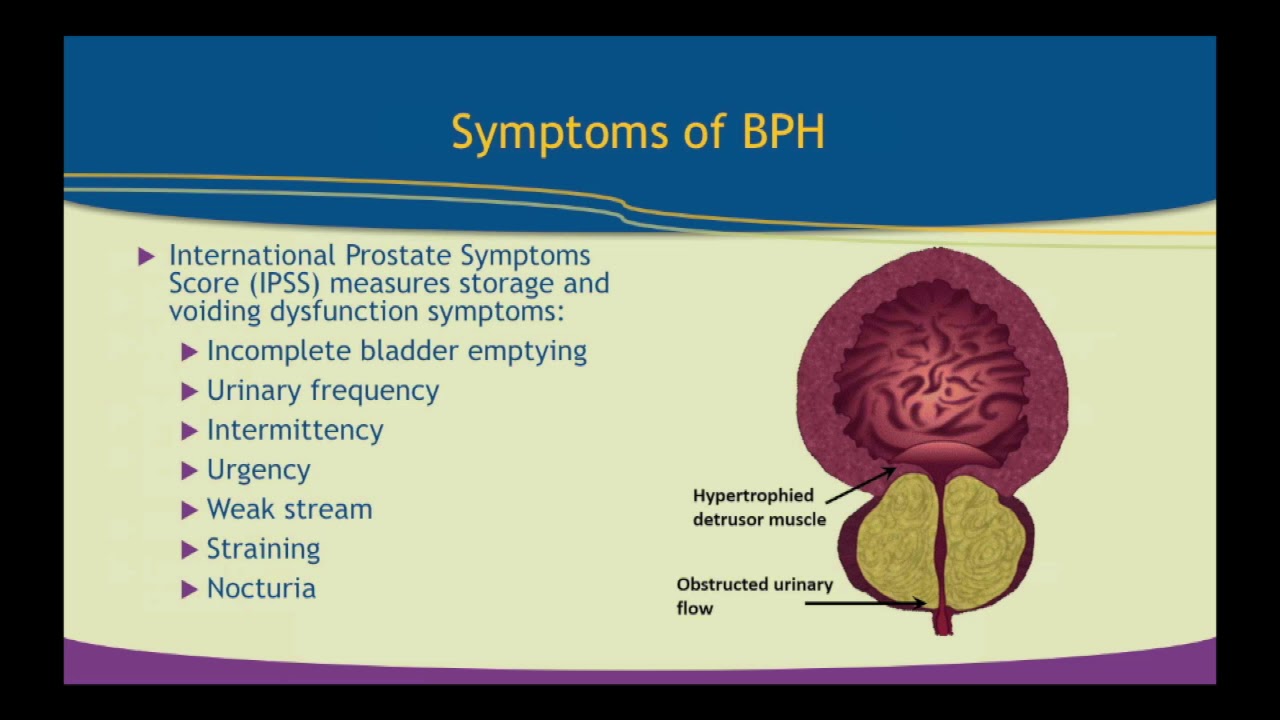 Benign Prostatic Hyperplasia: Clinical Focus and Treatment Protocols
