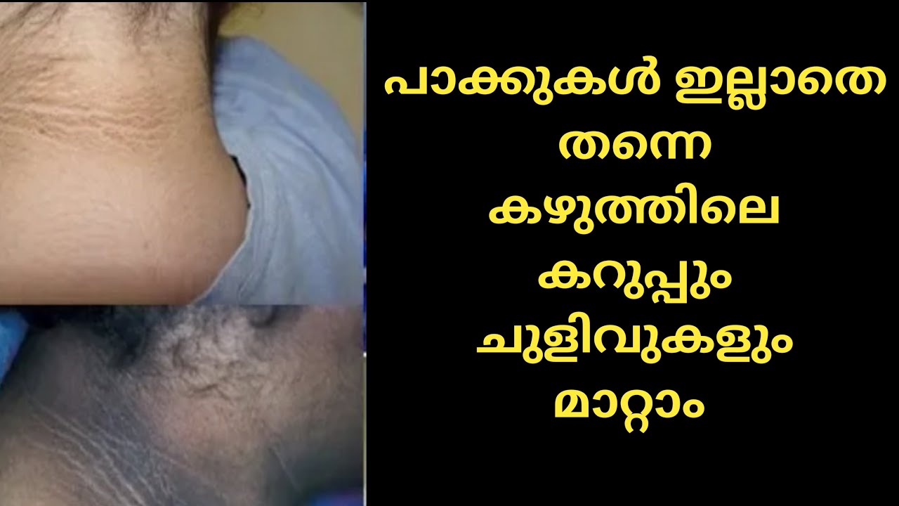 കഴുത്തിലെ കറുപ്പ്  Dark Neck ചുളിവുകൾ Wrinkles പായ്ക്ക് ഇല്ലാതെ തന്നെ മാറ്റാം|Neck Massage Malayalam