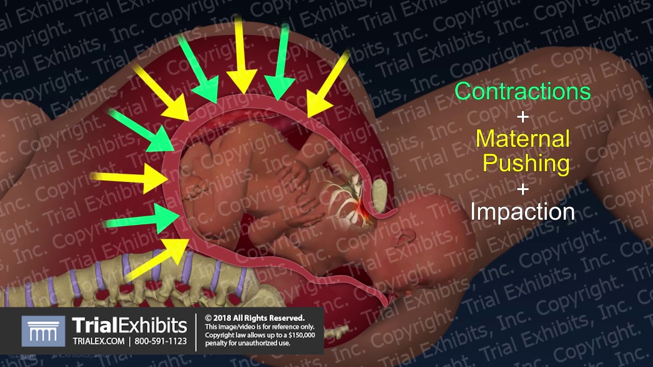 Maneuvers to Release Shoulder Dystocia During Delivery