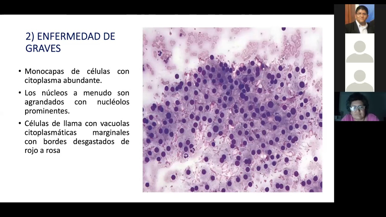 Sistema Bethesda para el reporte de la citología de tiroides: Parte 1