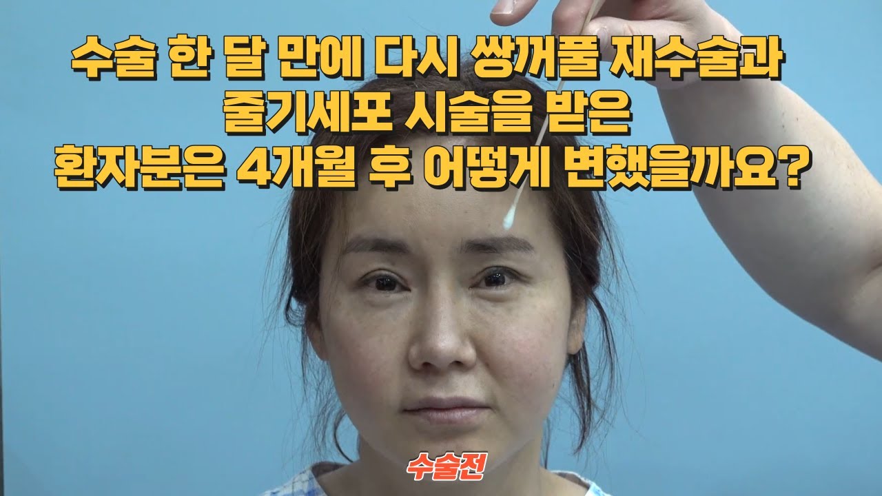 타 병원에서 쌍꺼풀 수술을 받고 다시  한 달 만에 쌍꺼풀 재수술과 줄기세포 시술을 받은 환자분은 4개월 후 어떻게 변했을까요?