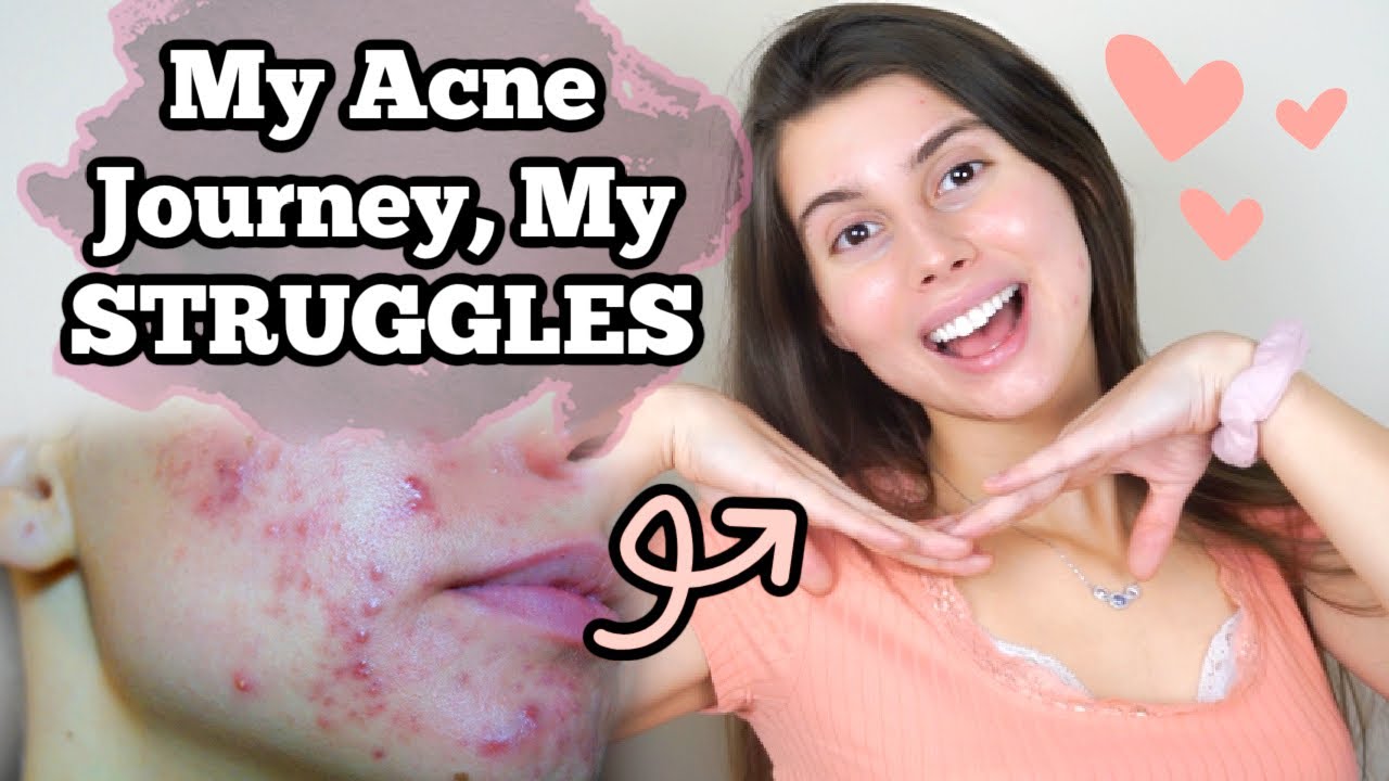I finally got rid of my acne... my story.