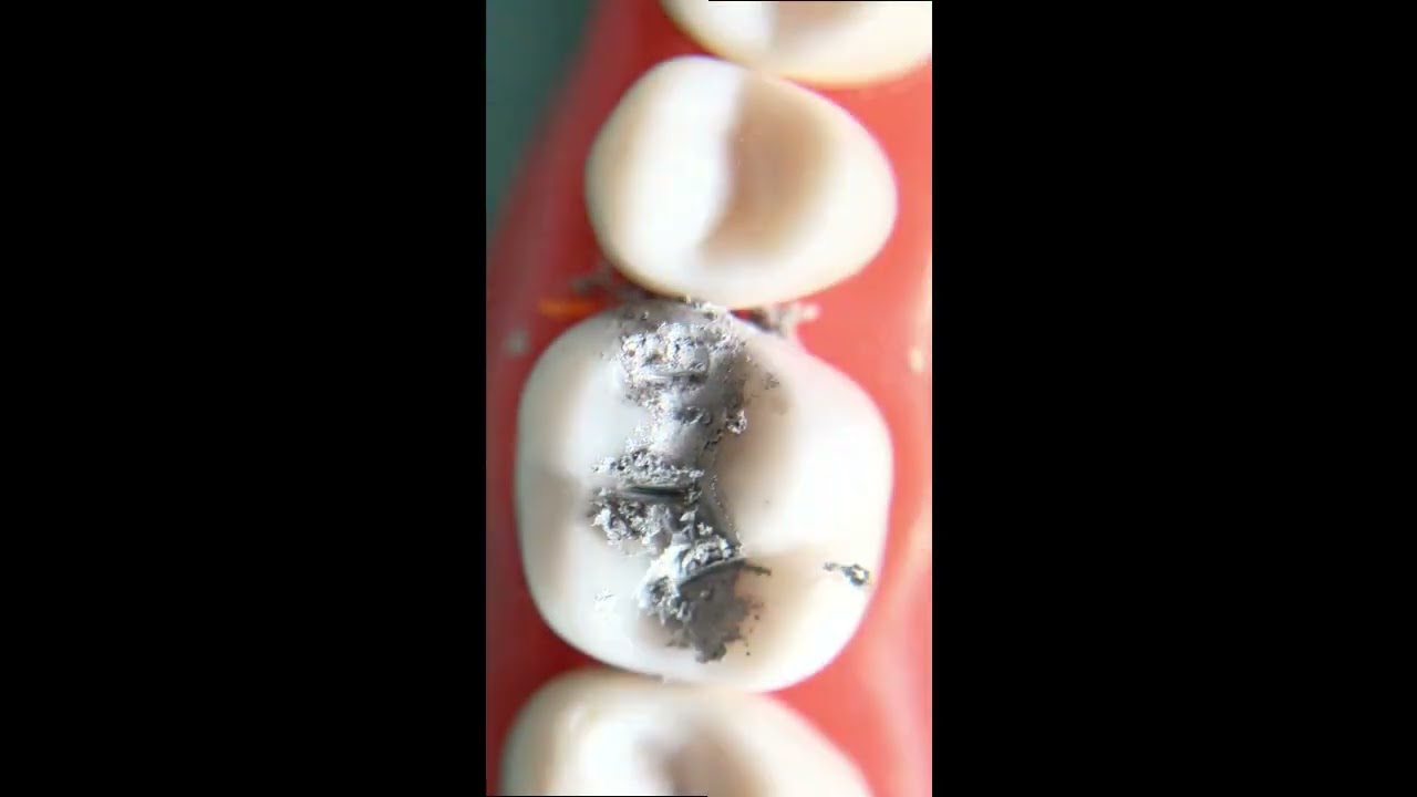 #3-MO Amalgam no Instruction