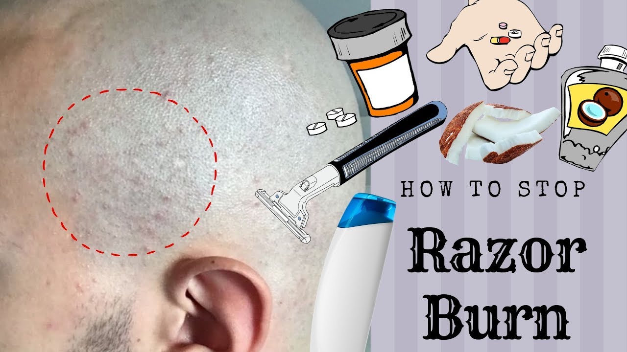 HOW TO STOP RAZOR BUMPS/BURN *Head Shave