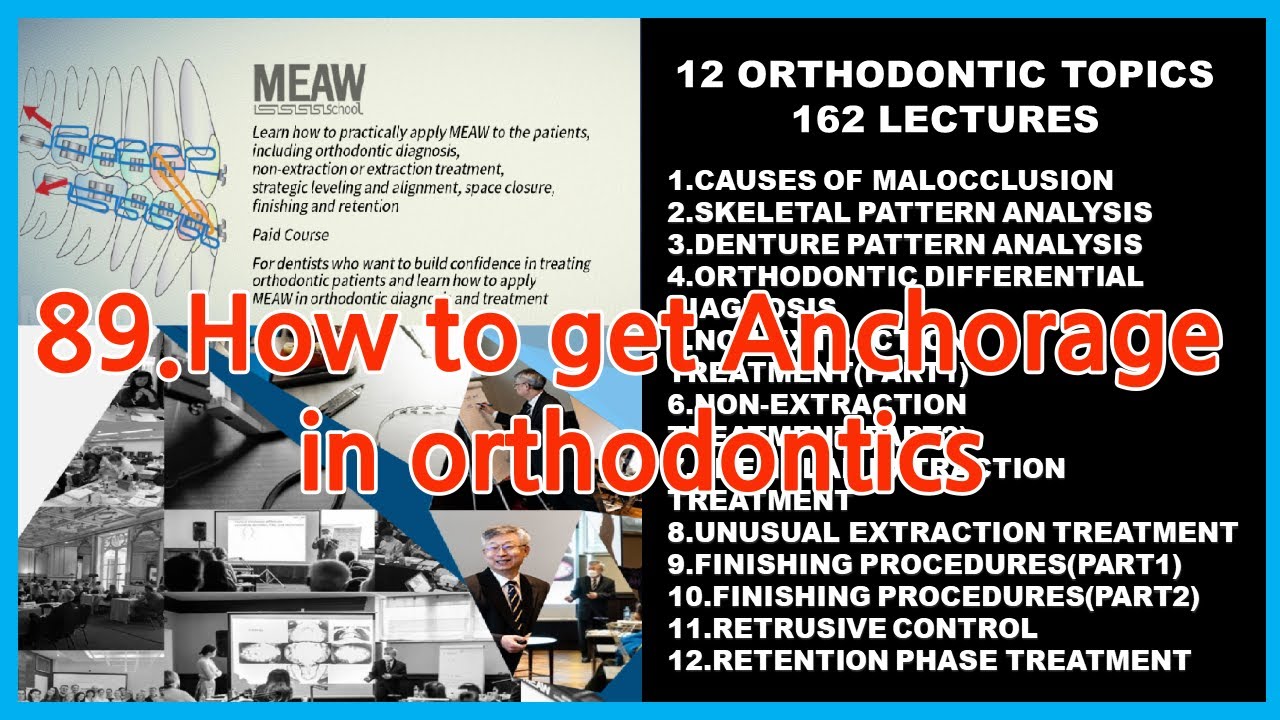 89.How to get Anchorage in orthodontics