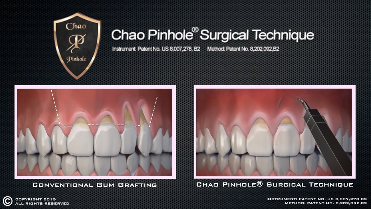 Chao Pinhole® Surgical Technique (PST) Animation 2015