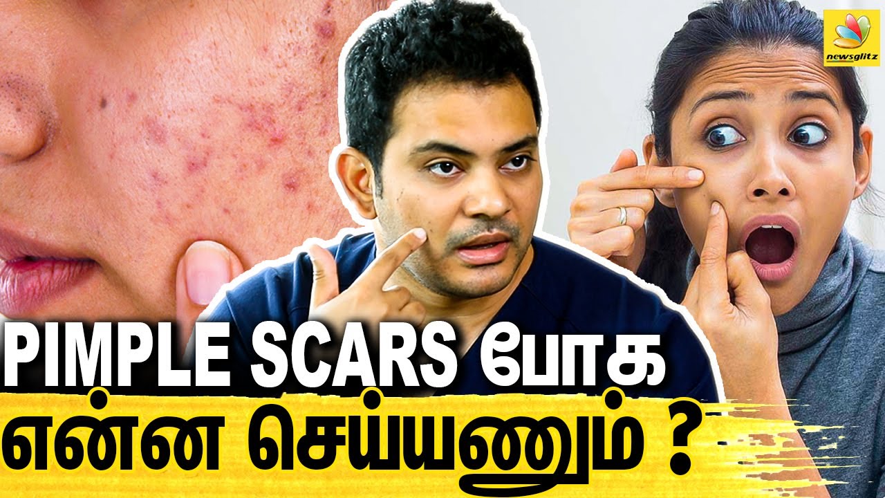 Pimple-அ Remove Panalama ? |  Dr Sethuraman Interview About Pimple Removing Tips & Treatment