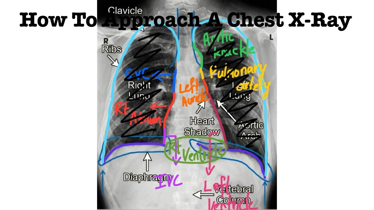 How To Read A Chest X-Ray for Undergraduates in 3 minutes 🔥🔥🔥