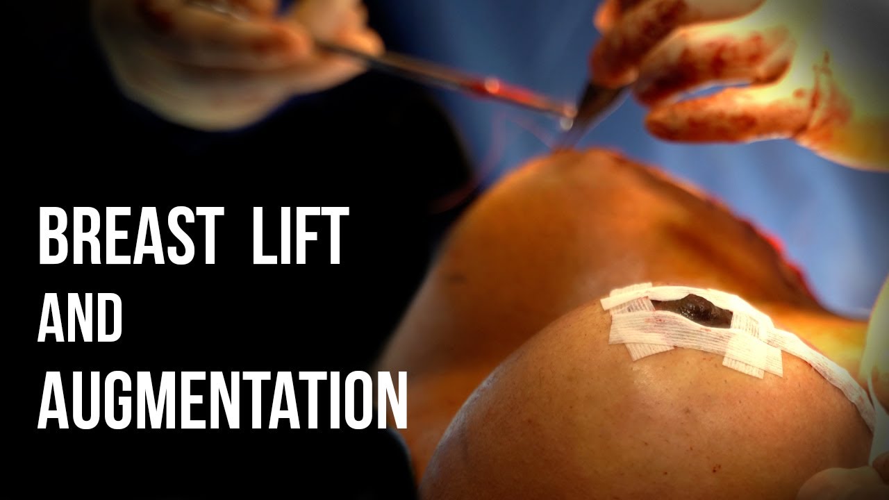 Breast Lift (Mastopexy) & Augmentation with Silicone Implants - Dr. Ruff | West End Plastic Surgery