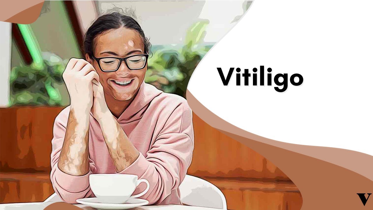 Quais os Tipos de Vitiligo? Veja as Causas e Riscos