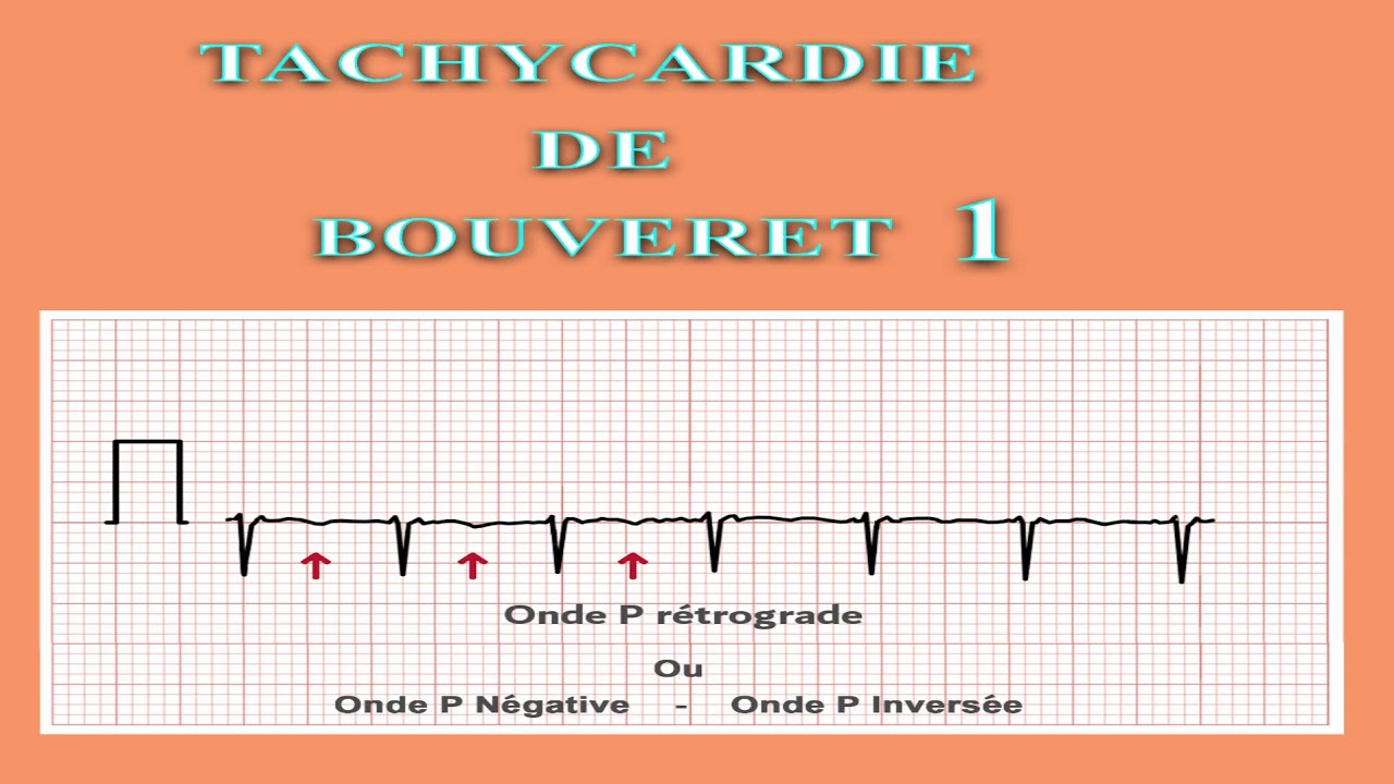 ECG Interpretation tres facile de l ECG  11eme partie TSV Tachycardie Jonctionnelle 1