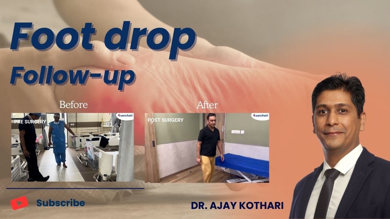 Foot Drop Follow-Up Patient: Recovery Progress & Care Explained | Dr. Ajay Kothari