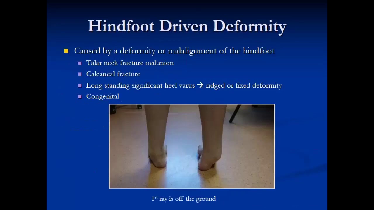 Ben Williams, MD, PGY 4  cavovarus  foot