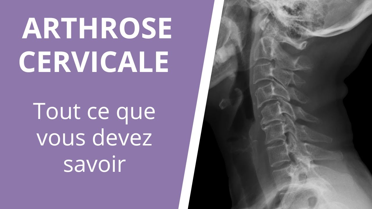 Tout ce que vous devez savoir sur l'arthrose cervicale : causes, symptômes et traitements