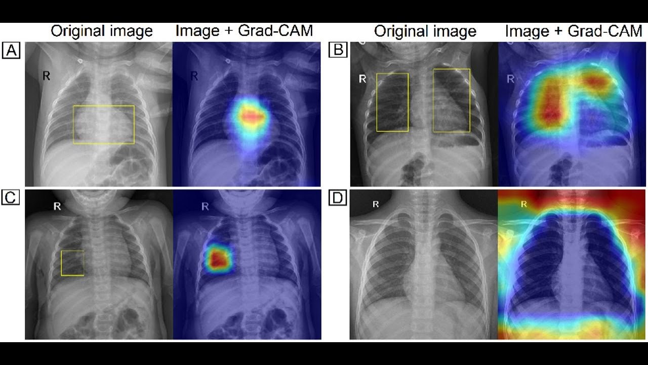 X-Ray with Grad-CAM (AI method)