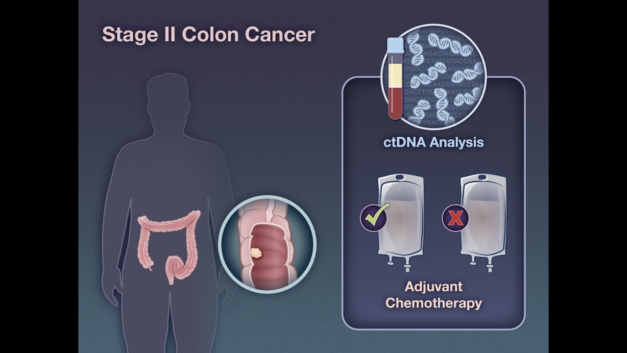 ctDNA-Guided Therapy in Stage II Colon Cancer | NEJM