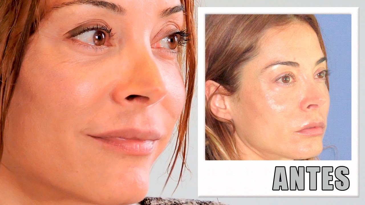 Radiofrecuencia Facial: Tratamiento de Thermage CPT | María